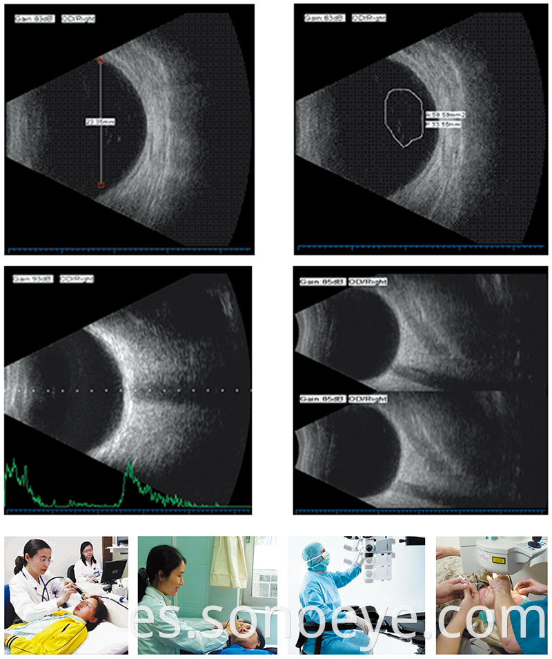 Eye Ultrasound Machina A/B Scanner